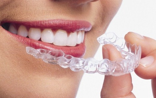 整牙兼整形 新技術結合隱形牙套與骨釘 | 文章內置圖片